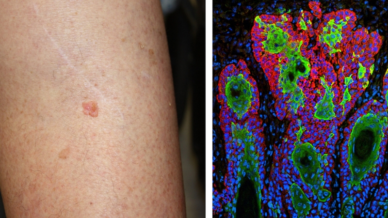 Squamous Cell Carcinoma On Leg